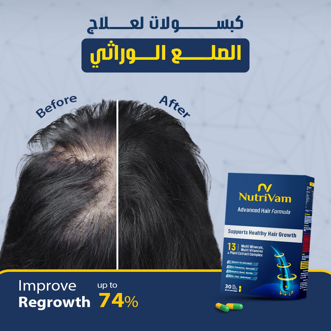 hereditary baldness treatment